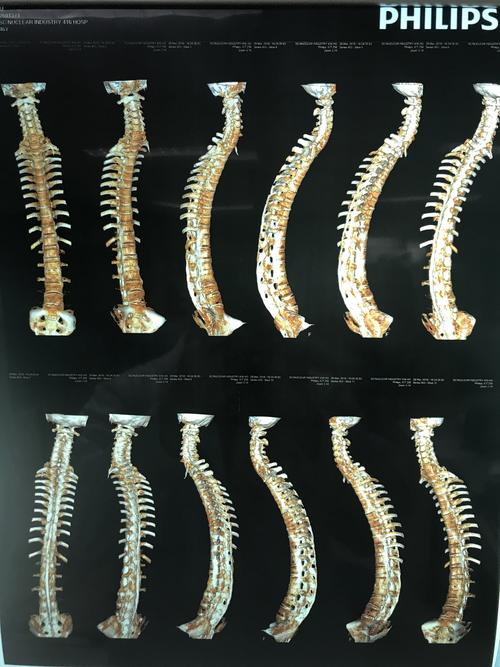 腰困加痛是强直性脊柱炎吗
