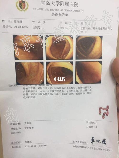 溃疡性结肠炎医院肠镜报告图片