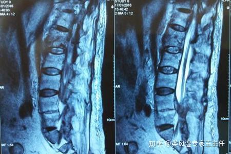 强直性脊柱炎能弯腰吗