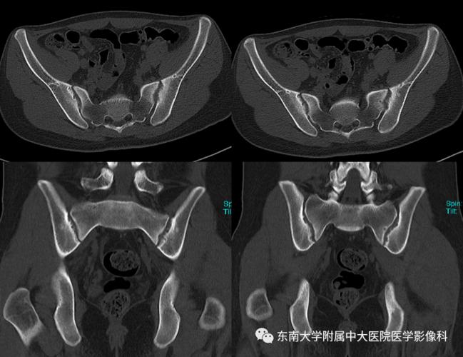 强直性脊柱炎竹节样改变ct报告