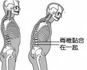 强直性脊柱炎脊柱硬