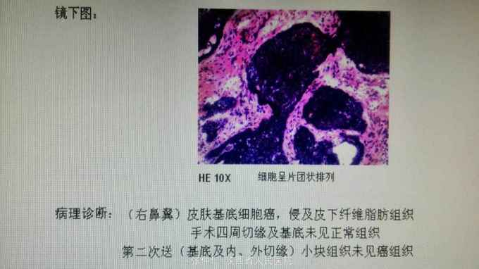 基底细胞癌