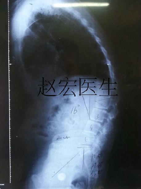 强直性脊柱炎半夜醒来背僵