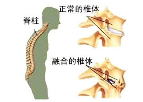 强直性脊柱炎一年犯一次