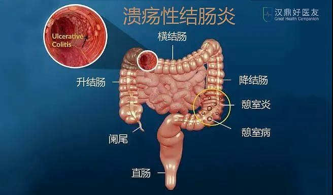 溃疡性结肠炎能吃烧烤