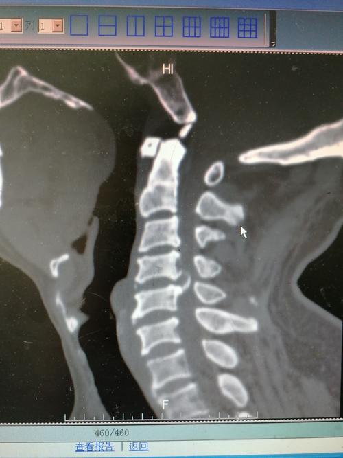 胸椎强直性脊柱炎ct影像表现