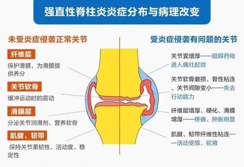 喝黄精水对强直性脊柱炎有帮助吗