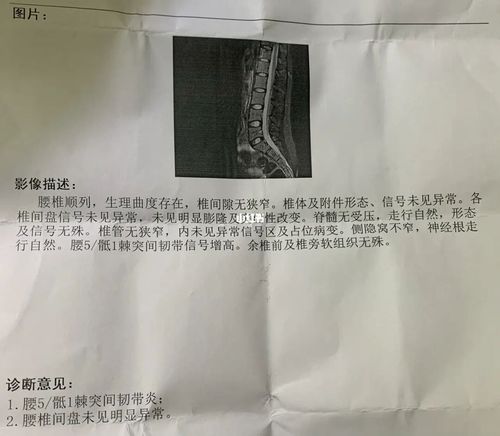 强直性脊柱炎棘间韧带炎