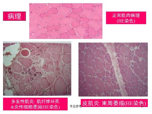 多发性肌炎