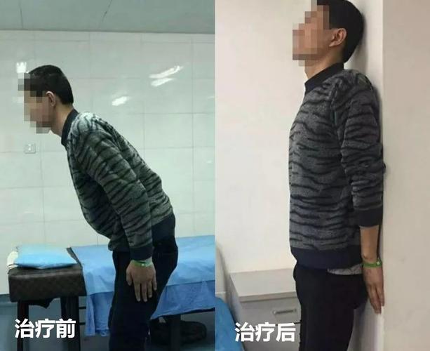 强直性脊柱炎列入特殊门诊