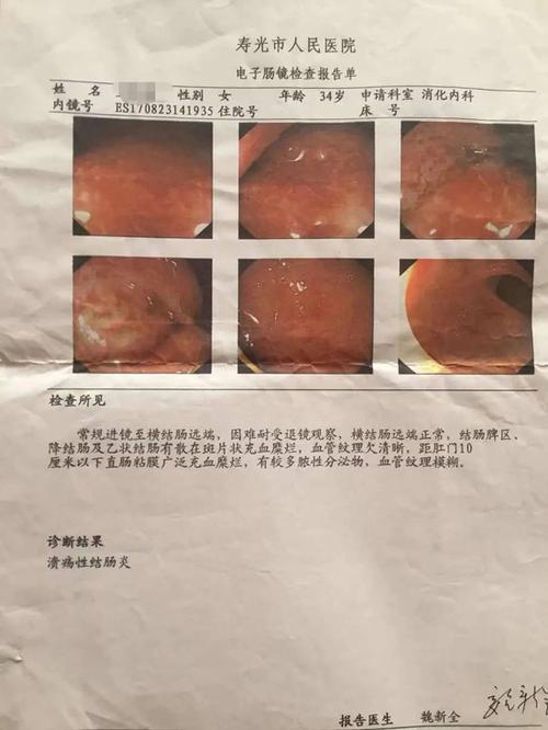 溃疡性结肠炎萎缩性胃炎吃啥药