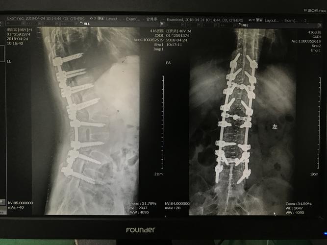 强直性脊柱炎针灸