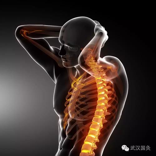 腰肌劳损就是强直性脊柱炎吗
