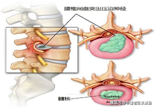 保护骨髓对强直性脊柱炎的好处