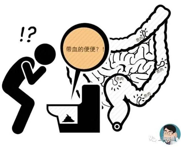 生物治疗溃疡性结肠炎时间