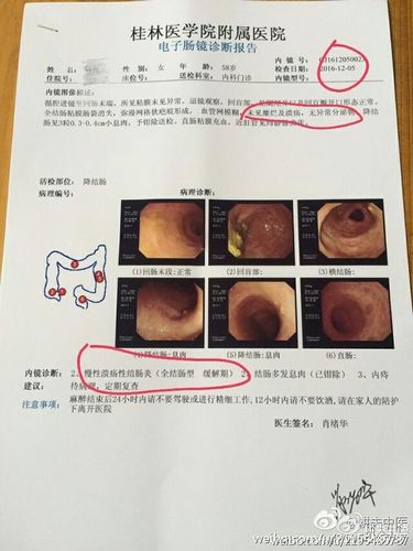 溃疡性结肠炎中药调理能全愈么