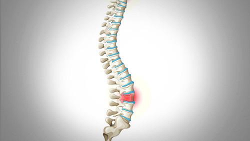 腰只有一边痛是强直性脊柱炎吗