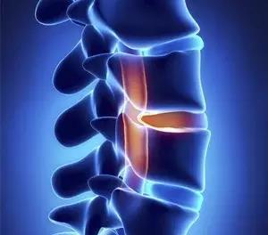 强直性脊柱炎的典型症状有哪些