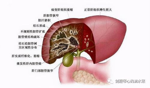 胆管癌