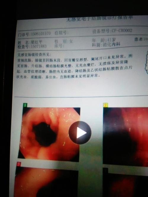 溃疡性结肠炎便秘吃整肠生有用吗