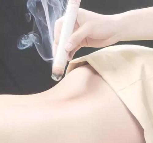 艾灸腰部治疗强直性脊柱炎