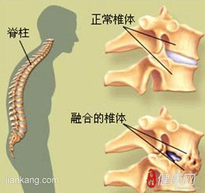 强直性脊柱炎40岁就不发展了嘛