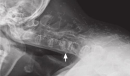 强直性脊柱炎做核磁增强正常