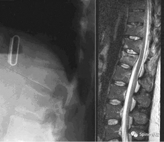 强直性脊柱炎骨质增生怎么治疗
