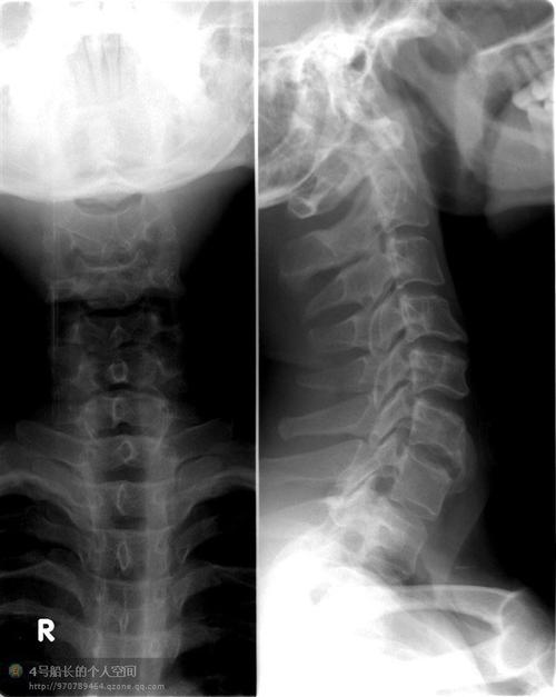强直性脊柱炎皮肤