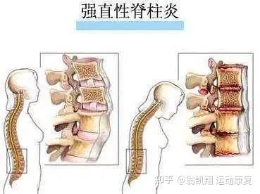 强直性脊柱炎可以解除股份合同吗