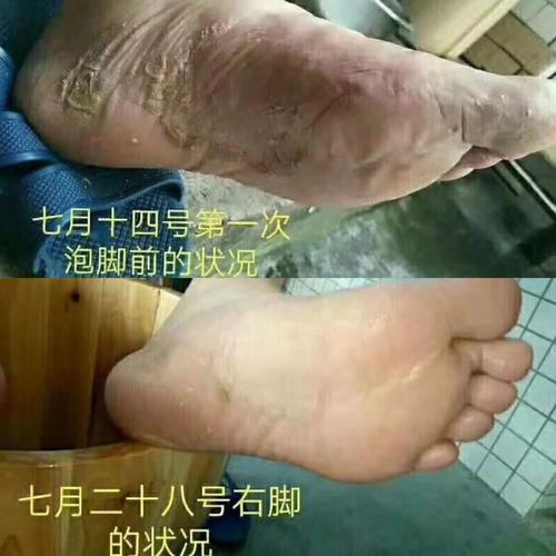 脚底发凉和强直性脊柱炎有关系吗