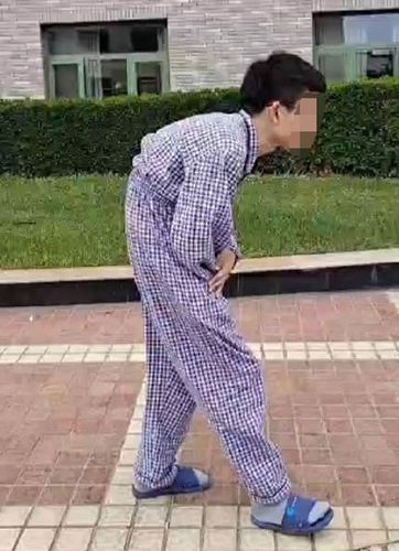 强直性脊柱炎要手术吗