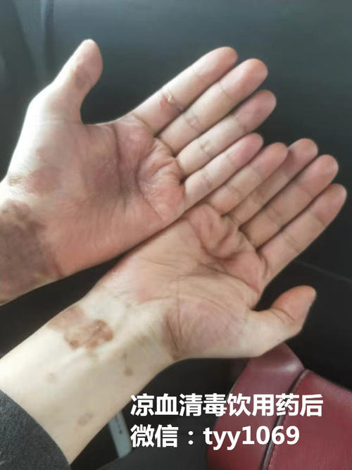 天疱疮