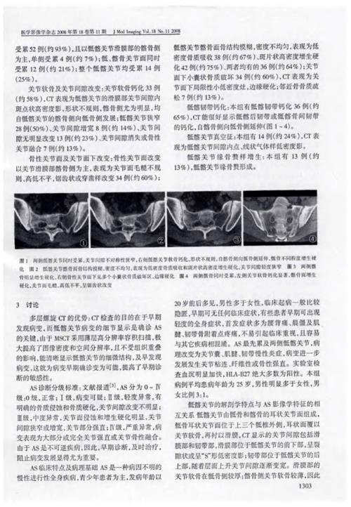 强直性脊柱炎骶髂关节针刀治疗