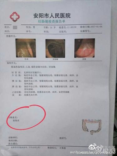 溃疡性结肠炎能不能吃汤圆