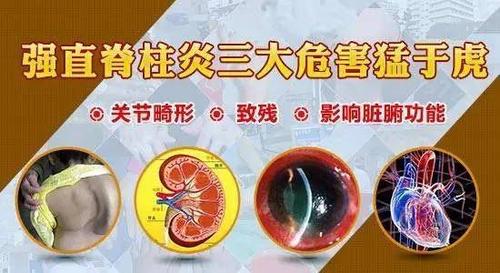 奶奶和母亲都有强直性脊柱炎