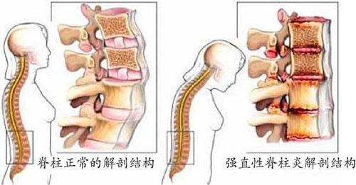 强直性脊柱炎练习八段锦