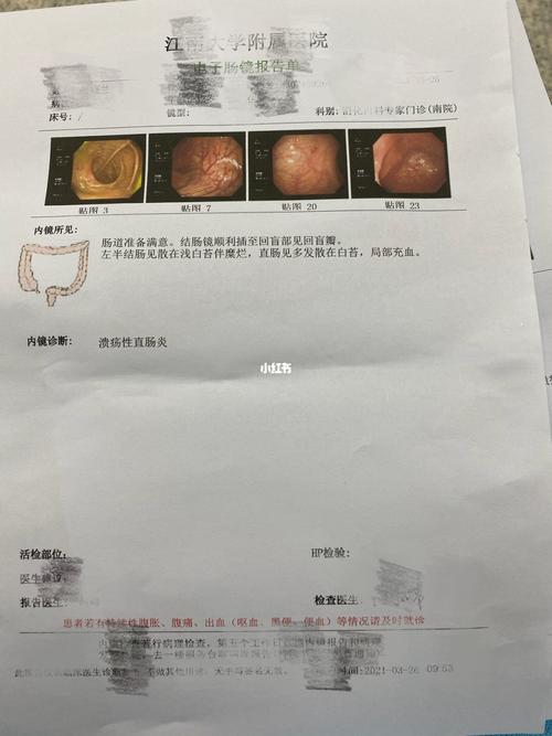 溃疡性结肠炎能吃点瘦肉吗