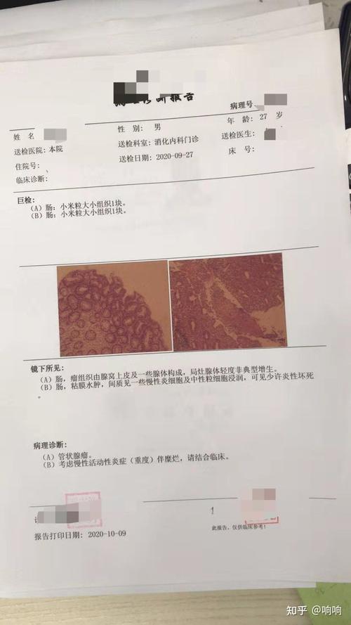 溃疡性结肠炎坚果抗炎