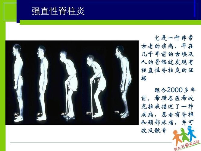 强直性脊柱炎伴发肿瘤是什么