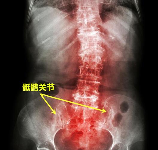 强直性脊柱炎病退标准