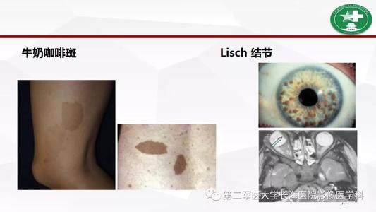 神经纤维瘤病