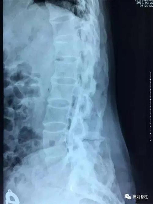 强直性脊柱炎肌营养不良