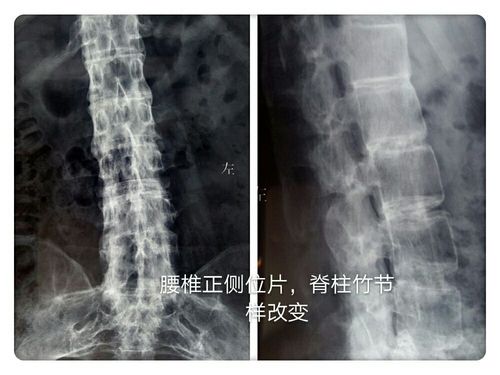 强直性脊柱炎为什么为什么影响脊柱和髋关节