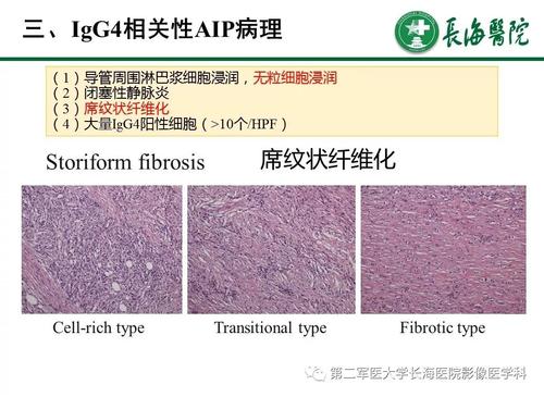 IgG4相关性疾病