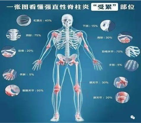 强直性脊柱炎会引起肺部受损吗