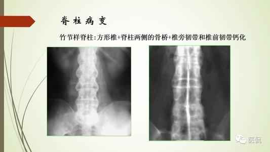 强直性脊柱炎怎么控制可以好转吗