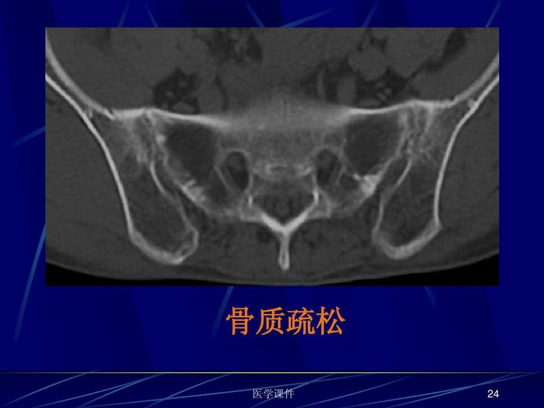 强直性脊柱炎骶髂关节ct分级