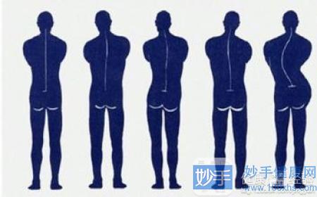 强直性脊柱炎