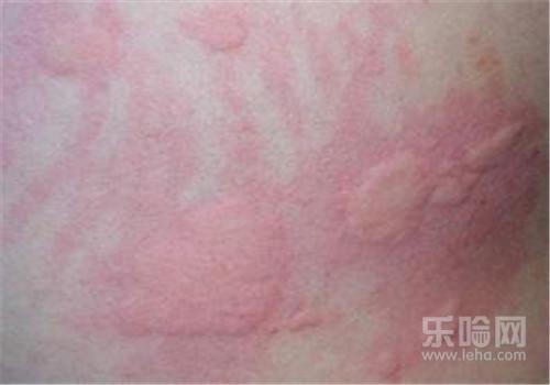 艾滋病和强直性脊柱炎有关系吗